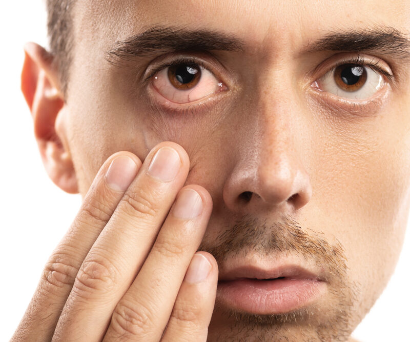How do you get Pink Eye? 4 Types of Conjunctivitis and Their Infection Methods