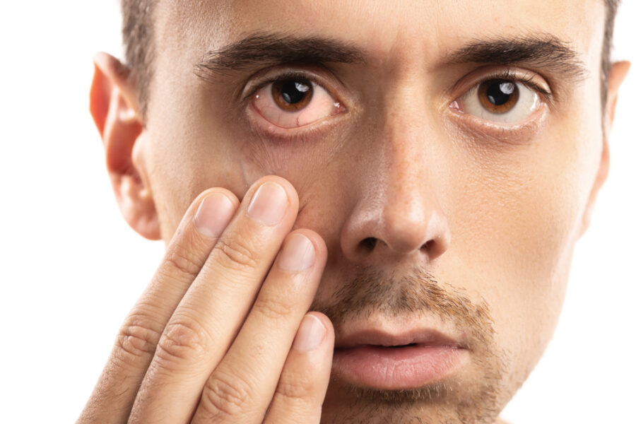 How do you get Pink Eye? 4 Types of Conjunctivitis and Their Infection Methods